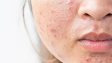 I rimedi naturali contro la pelle grassa