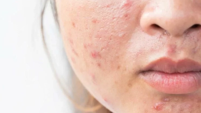 I rimedi naturali contro la pelle grassa