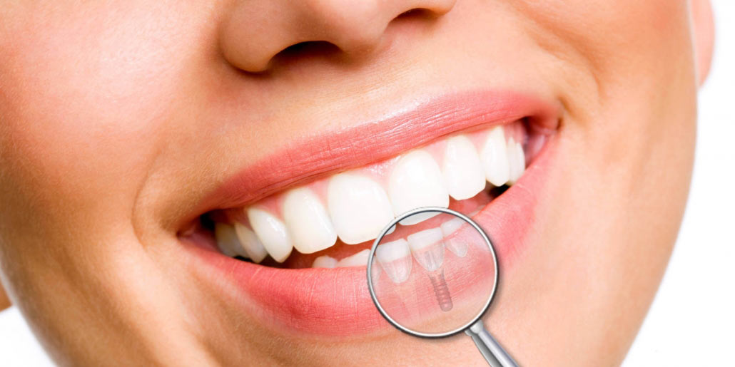 impianti dentali